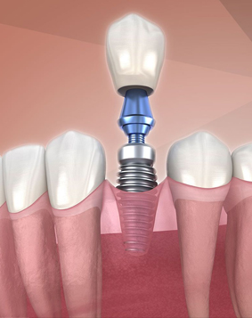 Trồng răng implant