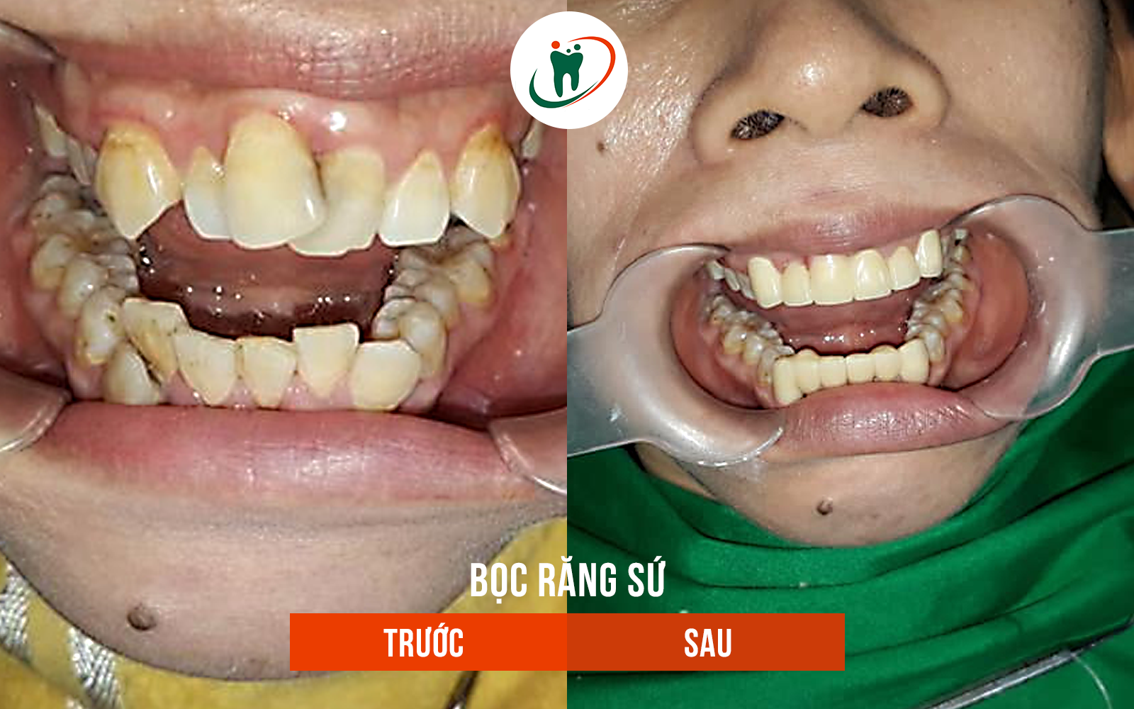 Trước và sau khi bọc răng sứ