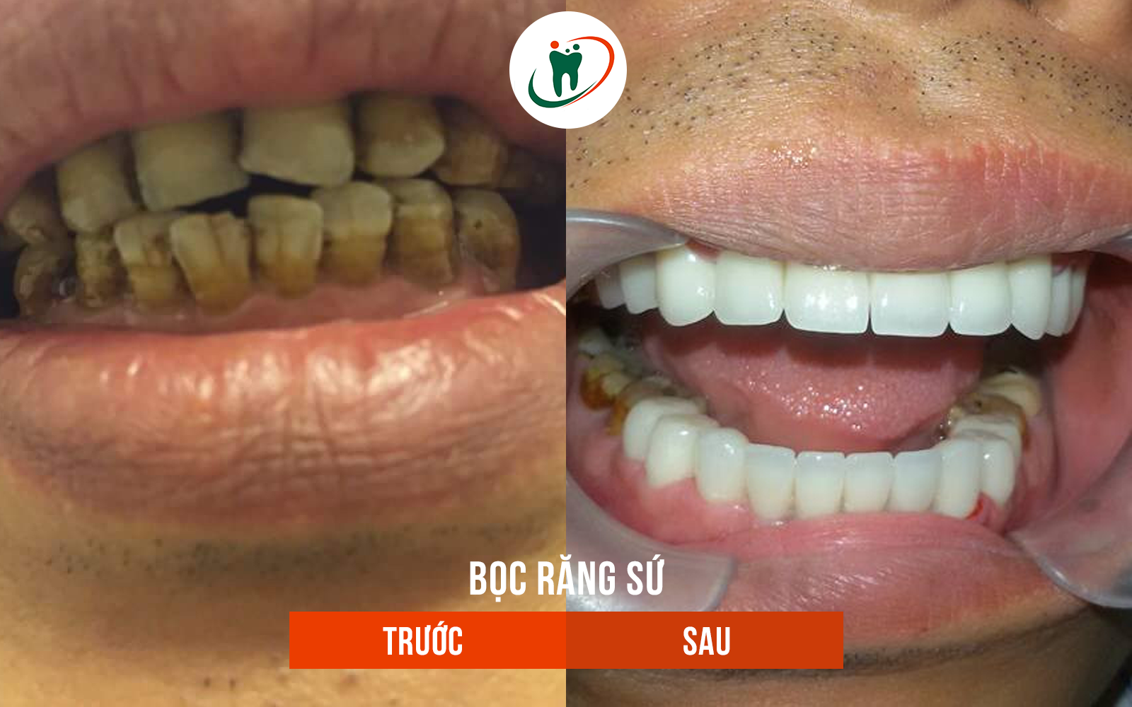 Trước và sau khi bọc răng sứ