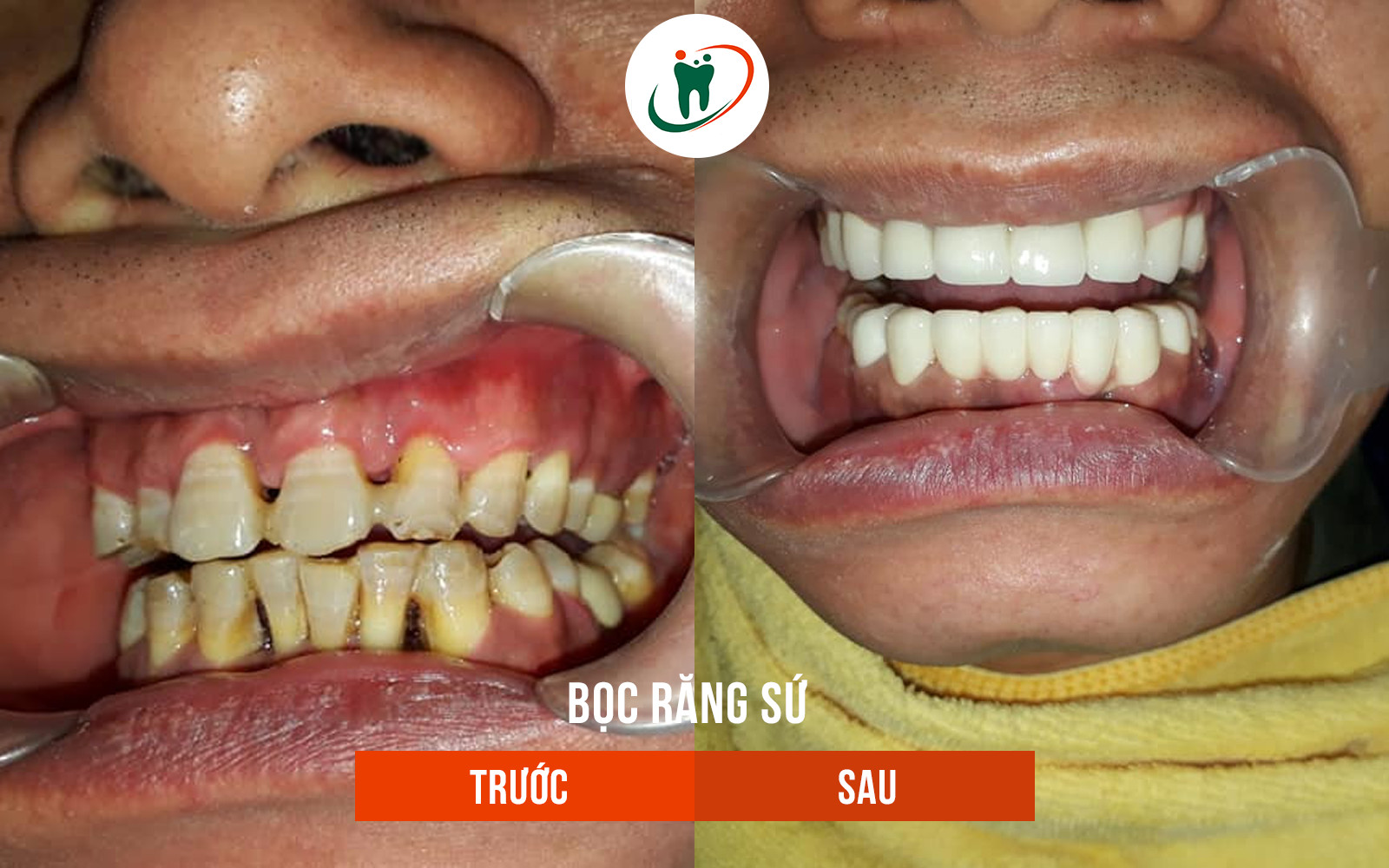 Trước và sau khi bọc răng sứ