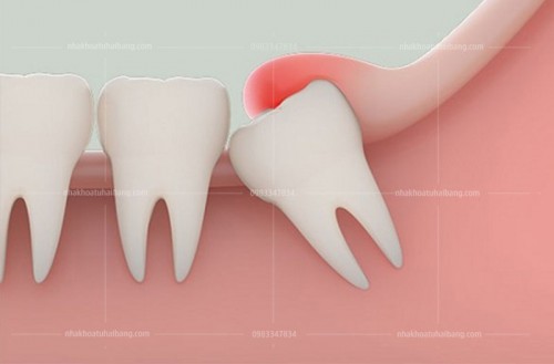 Lợi trùm là gì và có nên đi cắt lợi trùm không?