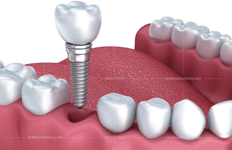 Cấy ghép  implant