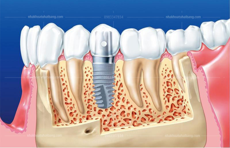 Cấy ghép  implant