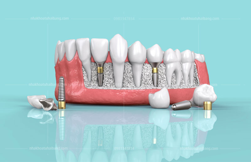 Cấy ghép  implant