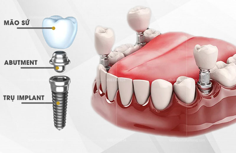 Cấy ghép  implant