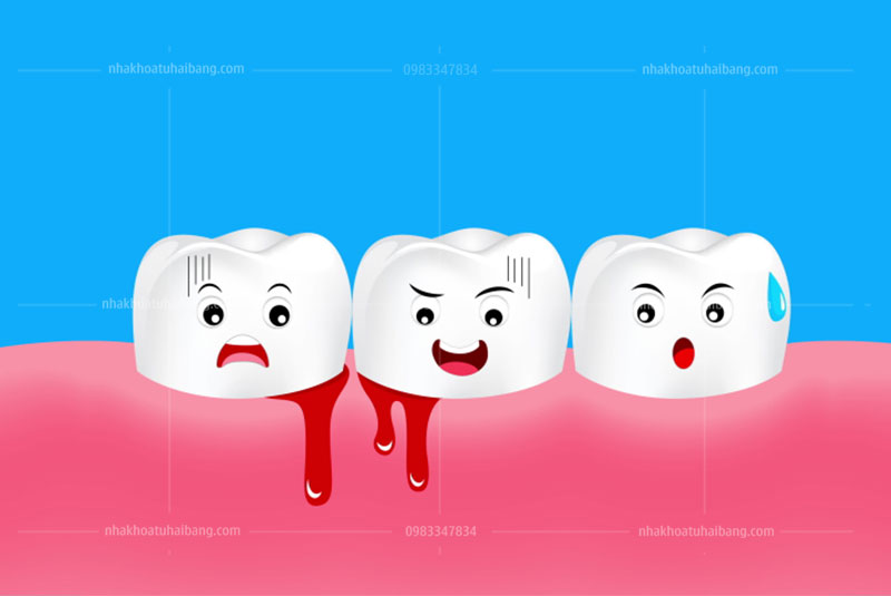 chảy máu chân răng