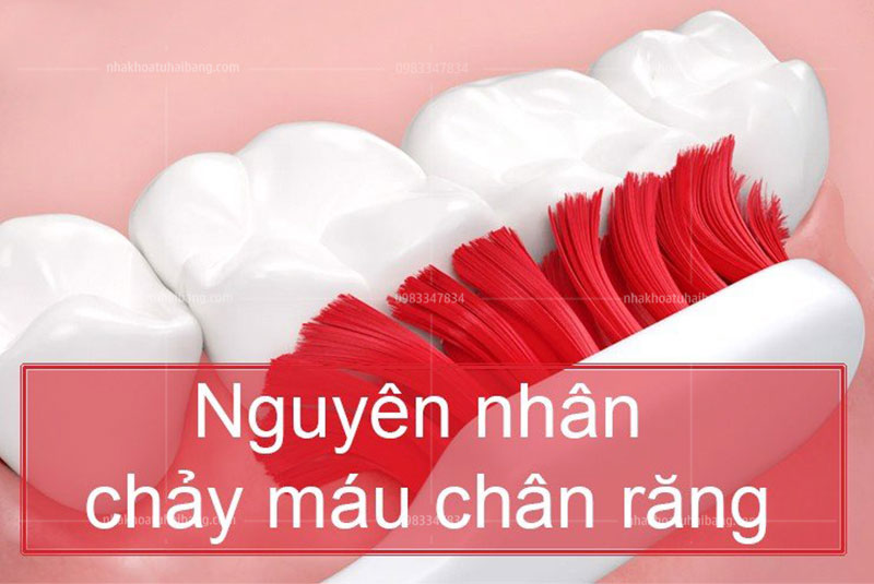 chảy máu chân răng