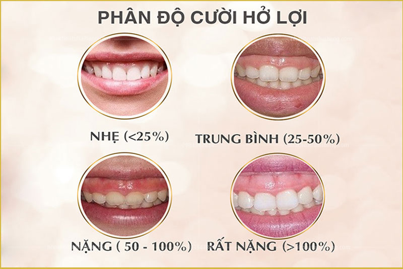 Những mức độ cười hở lợi 