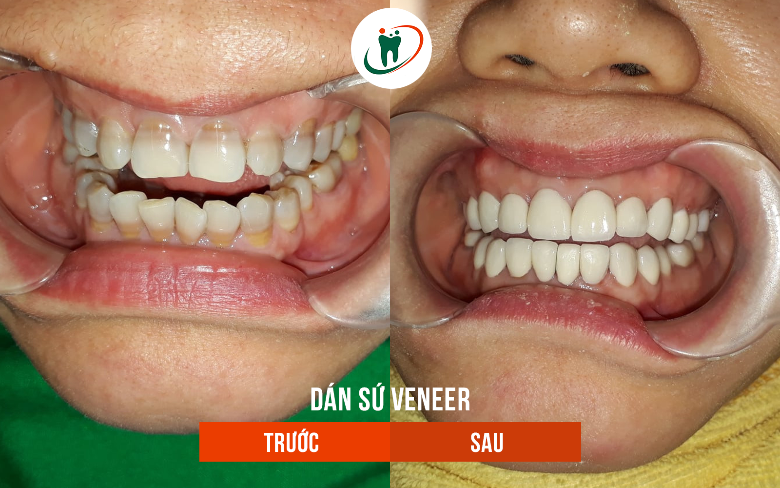 Trước và sau khi dán sứ Veneer 