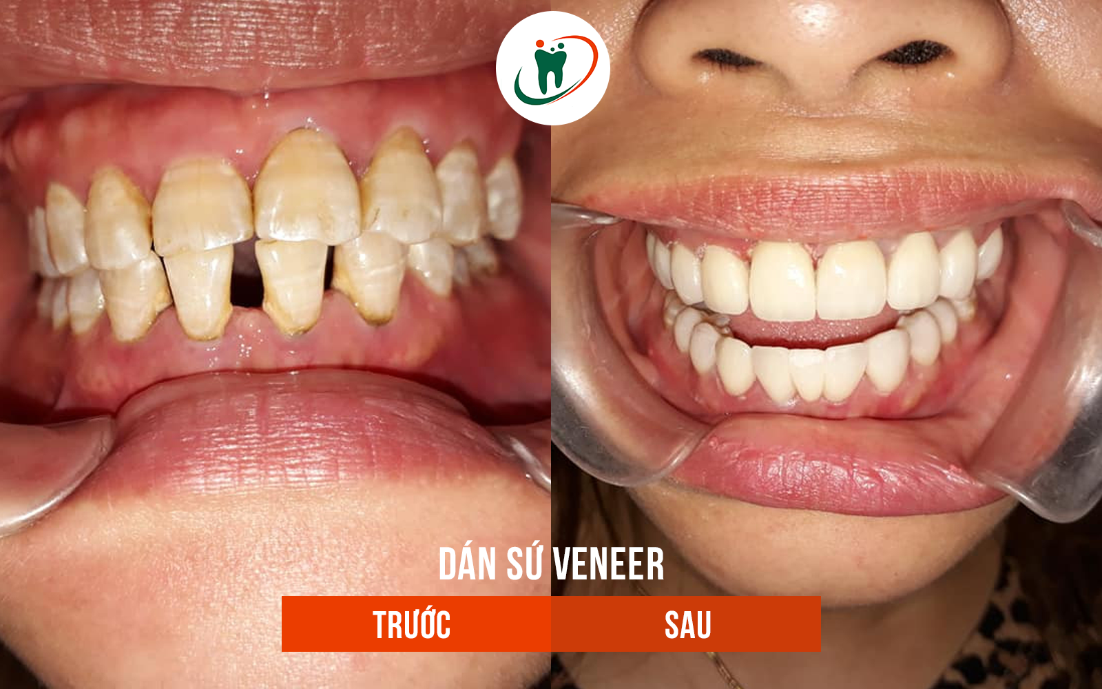 Trước và sau khi dán sứ Venner