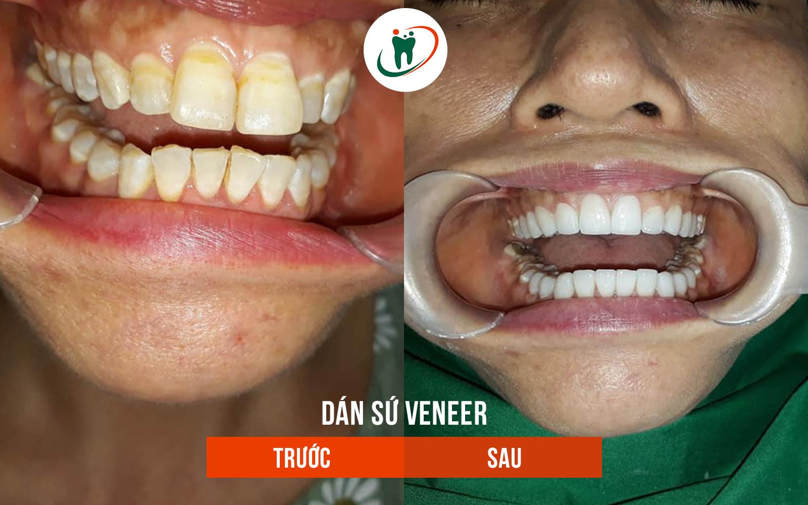 Trước và sau khi dán sứ Venner