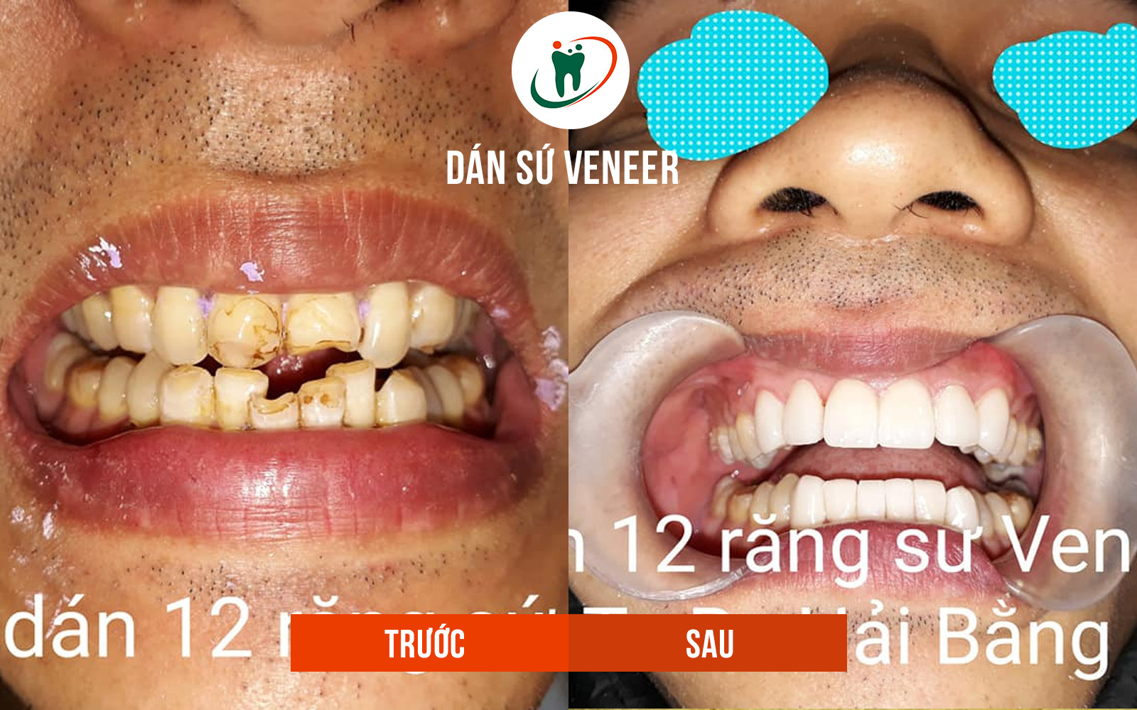 Trước và sau khi dán răng sứ venner