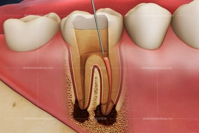 điều trị tủy răng