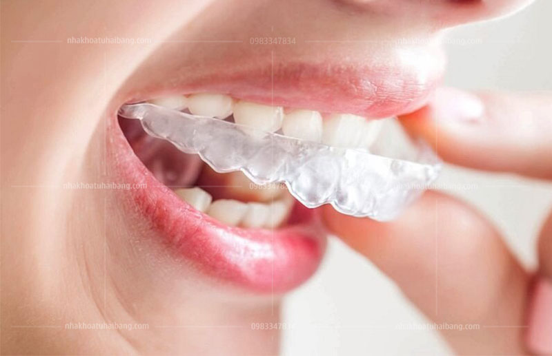 Niềng răng Invisalign 