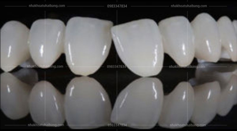 Răng Răng sứ Emax Zirconia