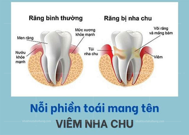 Viêm nha chu